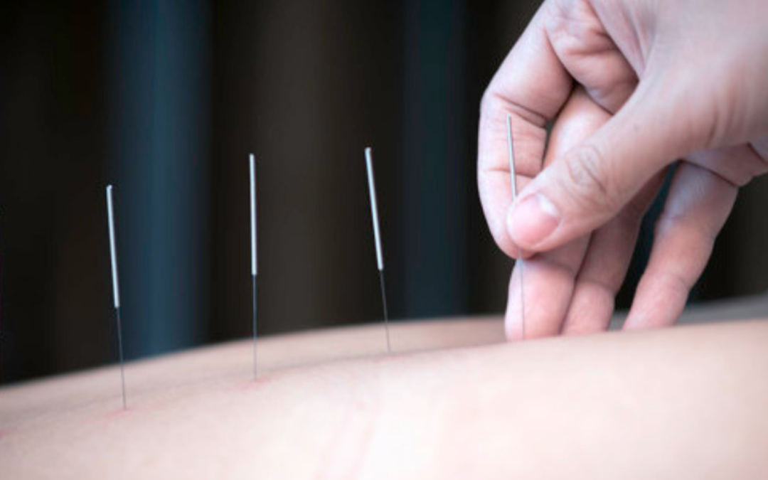 Acupuncture Outperforms These Three Common Drugs