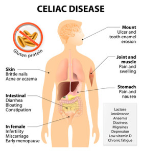 celiac disease - Sophia Natural Health