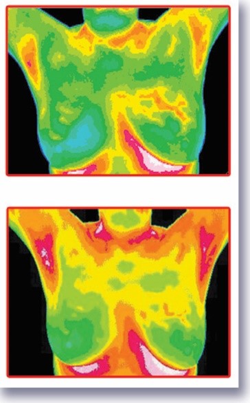 October Is Breast Cancer Awareness Month – Why Haven’t You Gotten Your Thermogram Yet?