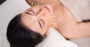 woman acupuncture face
